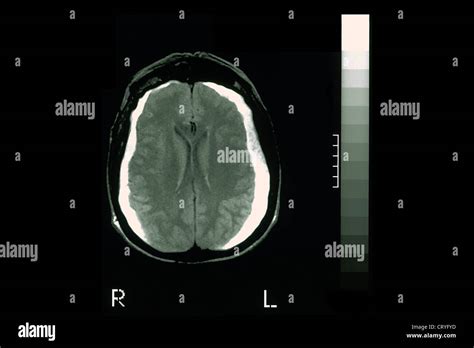 Hematoma Brain Mri Stock Photo Alamy