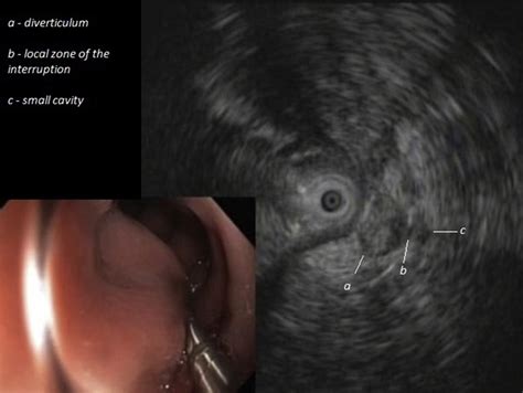 Su1444 Eus Colonoscopy Detection Of The Ruptured Diverticulum In