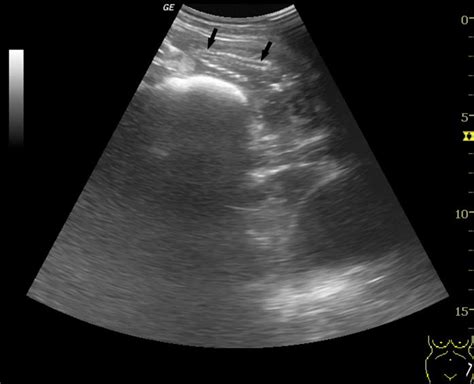 A A 21 Year Old Female Patient With Uterine Perforation And Abdominal