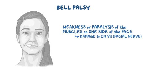 Bell Palsy Nursing Osmosis Video Library