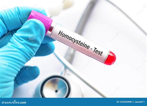 Blood Sample Tube for Homocysteine Test Stock Photo - Image of medicine, myoglobin: 122534498