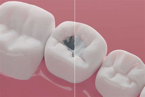 Safe Mercury Amalgam Removal At Sonrise Dental Smart Protocol