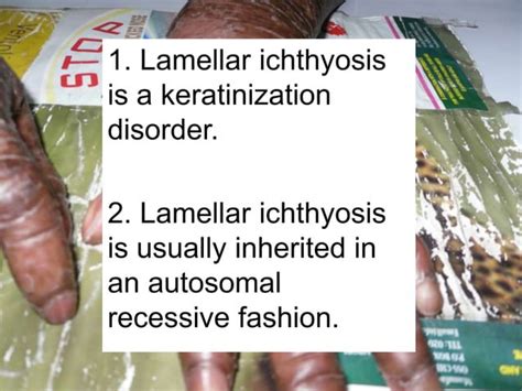 Lamellar ichthyosis