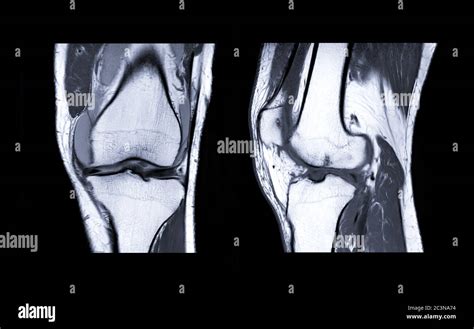 Anterior Cruciate Ligament Tear Ct Scan By Du Cane Medical