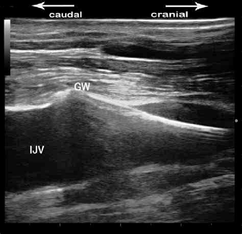 Long Axis Ultrasound Image Of The Internal Jugular Vein And The