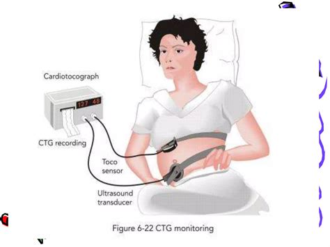 Cardiotocography Ppt