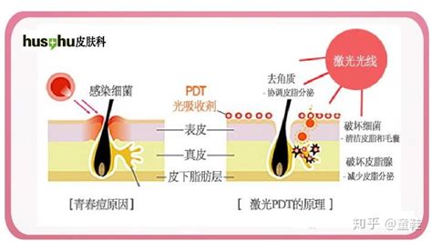 痘痘肌必看：教你正确认识痘痘，如何正确祛痘！ 知乎