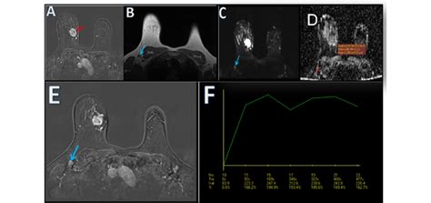 A 36 Year Old Female With A Right Breast Upper Inner Quadrant Malignant Download Scientific