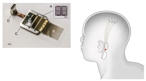 Elon Musk demonstrará um dispositivo Neuralink em funcionamento ao vivo