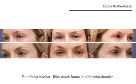 Botulinumtoxin Botox Krähenfüsse Zornesfalten Faltenbehandlung