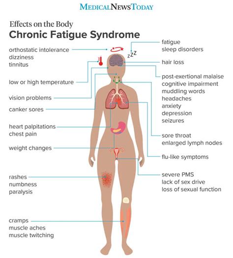 Chronic Fatigue Syndrome