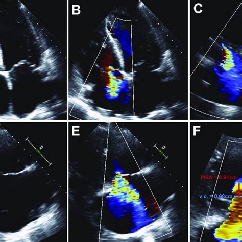 Ecg Gated Mdct Findings After Aortic And Mitral Valve Surgery