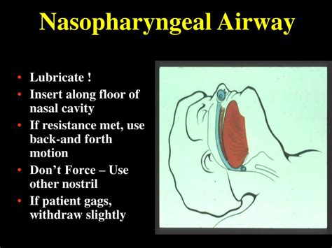 Ppt Airway Management Powerpoint Presentation Free Download Id6720547