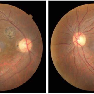 Color Fundus Photograph Of The Second Case Left The Posterior Pole