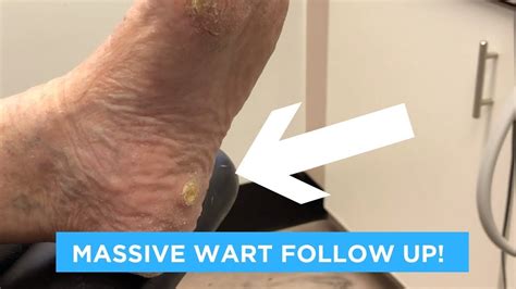 Massive Wart Follow Up Youtube