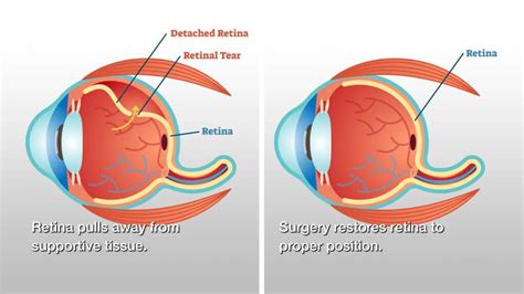 Retinal Detachment Treatment And All About It Healing Clinic Turkey