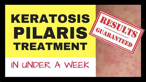 Keratosis Pilaris Treatment Keratosis Pilaris Treatment Before And After Youtube