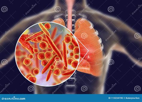 Bacterias De Los Pneumoniae Del Micoplasma En Pulmones Humanos Stock De