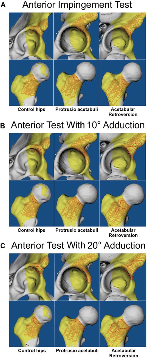 Figure From Location Of Intra And Extra Articular Hip Impingement Is