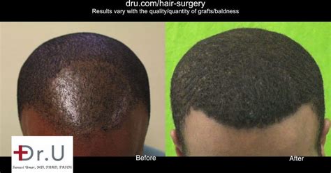 Video Follicular Unit Extraction Fue Hair Transplant Services Los Angeles