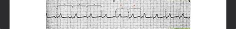 Cardio Pulmonary Ecgs Flashcards Quizlet