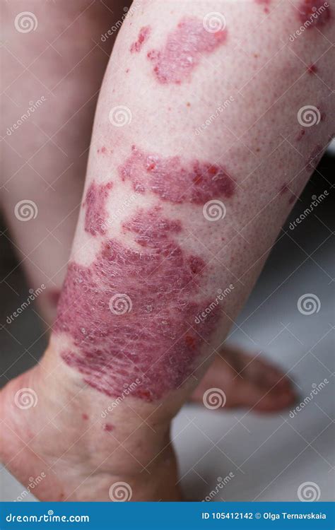 Allergic Rash Dermatitis Eczema Skin On Leg Of Patient Psoriasis And