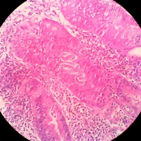 Histopathology Of The Duodenal Mucosa Showing Mixed Inflammatory