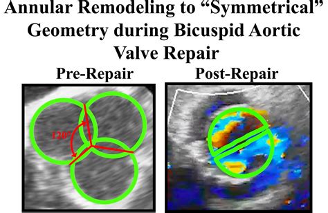 Commentary Achieving “symmetrical” Annular Geometry During Bicuspid Aortic Valve Repair The