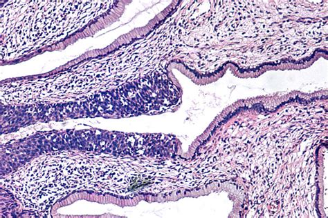 Squamous Cell Carcinoma Of The Uterine Cervix Libre Pathology