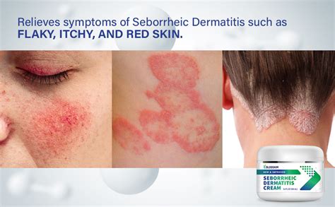 Seborrheic Dermatitis Cream Fast Acting Treatment For Face Scalp