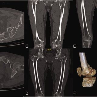 Three Dimensional Reconstruction Of Computed Tomography Imaging Of