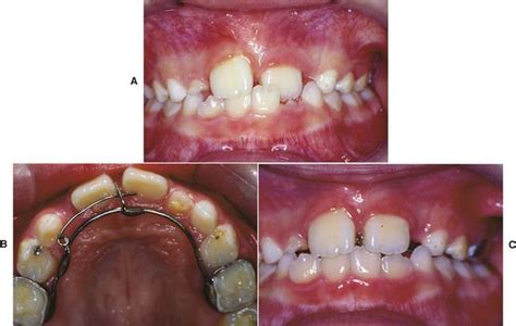 14 Class Iii Correctors Pocket Dentistry