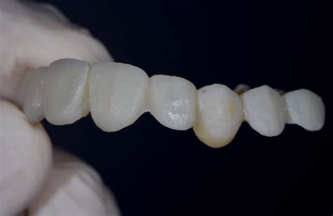 Ovate Pontic For The Correct Emergence Profile A Clinical Case