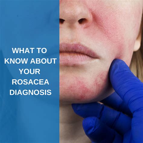 What To Know If Youve Been Diagnosed With Rosacea Savannah River