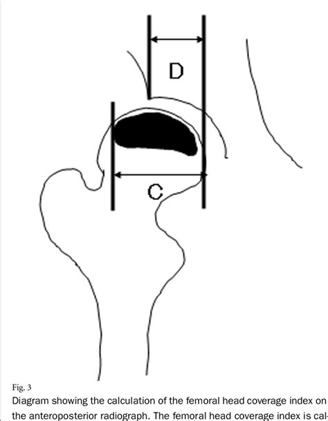 Figure 3 From Rotational Acetabular Osteotomy For Osteonecrosis With