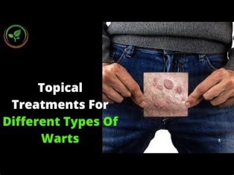 Topical treatments for different types of warts || how to treat warts ...