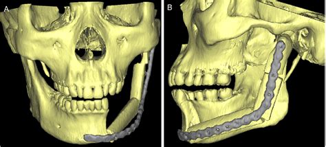 Figure 4 From Mandibular Reconstruction With The Vascularized Fibula