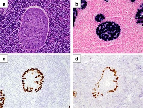 A Tumor Hande 400x B Epsteinbarr Virus In Situ Hybridization Shows Download Scientific