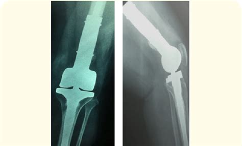 Post Operative Radiographs Anteroposterior And Lateral View