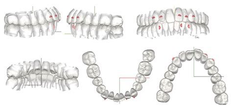 Quality And Affordable Orthodontic Appliances M And R Orthodontic Lab