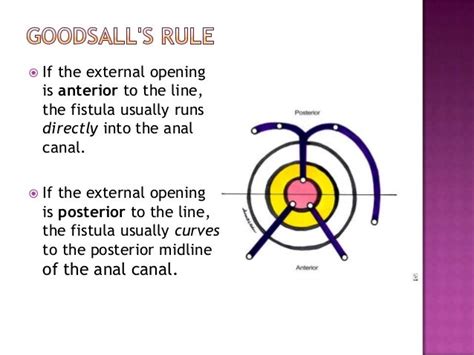 Fistula in ano