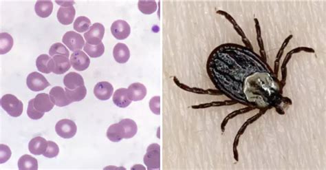 Here Are 8 Diseases You Can Get From Ticks You Probably Didn't Know Existed