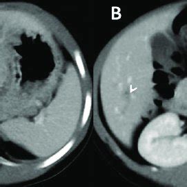 Ultrasound shows altered coarse echotexture of liver with architectural... | Download Scientific ...