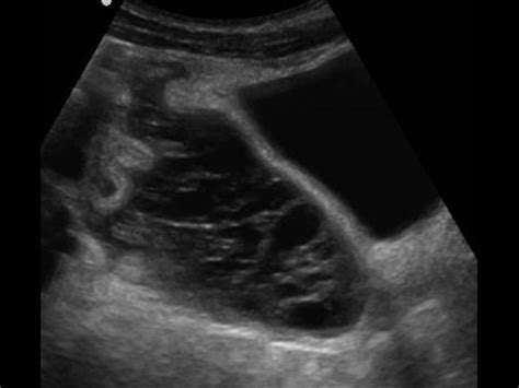 Intra Abdominal Abscess