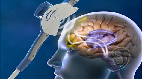 FDA Approves Medtronic S Deep Brain Stimulation Therapy For Refractory