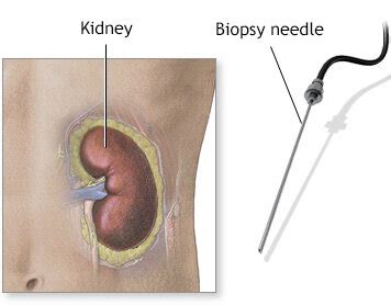 Histo Biopsy Liver Needle Biopsy Test Best Pathology Lab And