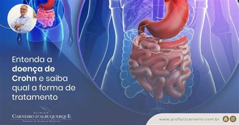 Doença De Crohn Tempo De Vida - Entenda A Doença De Crohn E Saiba Qual A Forma De Tratamento - Prof Dr ...