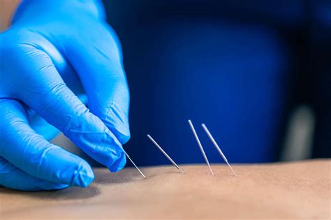 Dry Needling For Pelvic Pain Relief Insights From Pelvic Floor Experts