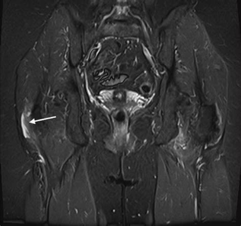 Scapulothoracic Bursitis Mri