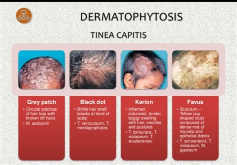 Dermatophytoses - MEDizzy